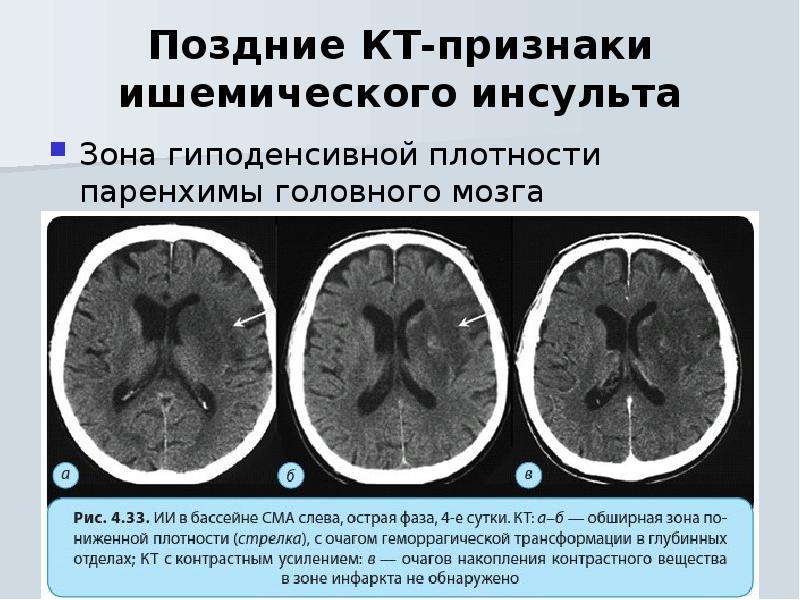 Изображение взвешенное по протонной плотности