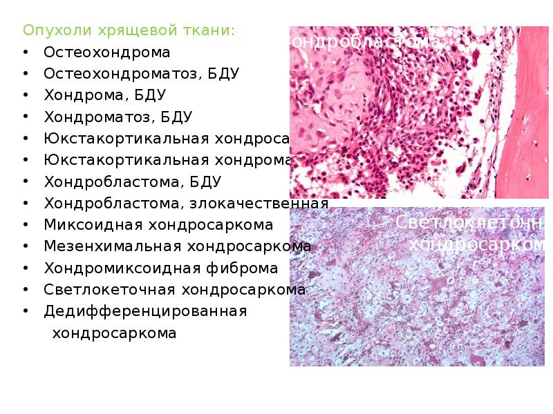 Опухоли из тканей. Опухоли хрящевой ткани. Опухоли из хрящевой ткани. Доброкачественная опухоль из хрящевой ткани. Юкстакортикальная хондросаркома.