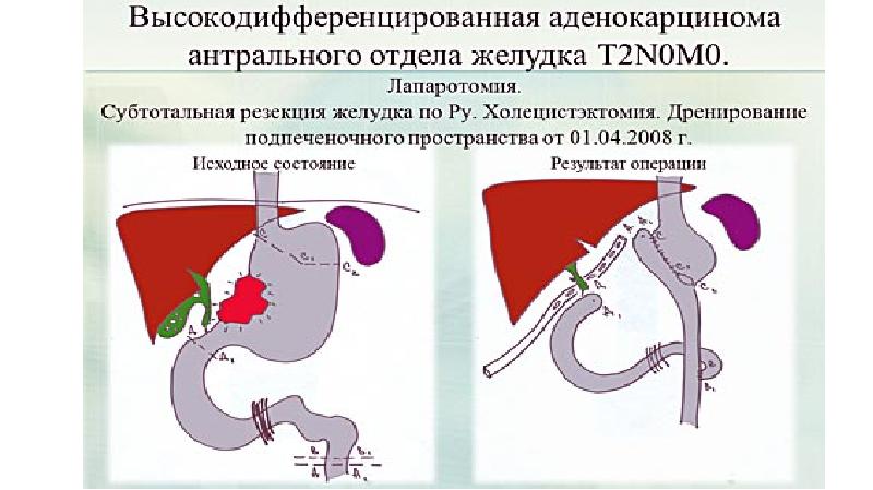 Язвенная болезнь хирургия презентация