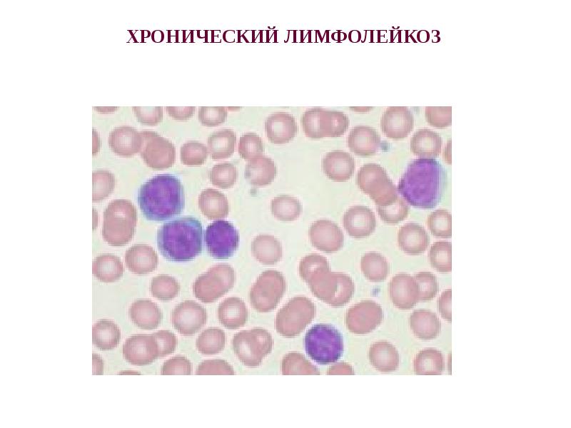 Б лимфолейкоз. Клетки Боткина Гумпрехта это. Острый лимфобластный лейкоз мазок. Тени Боткина Гумпрехта.