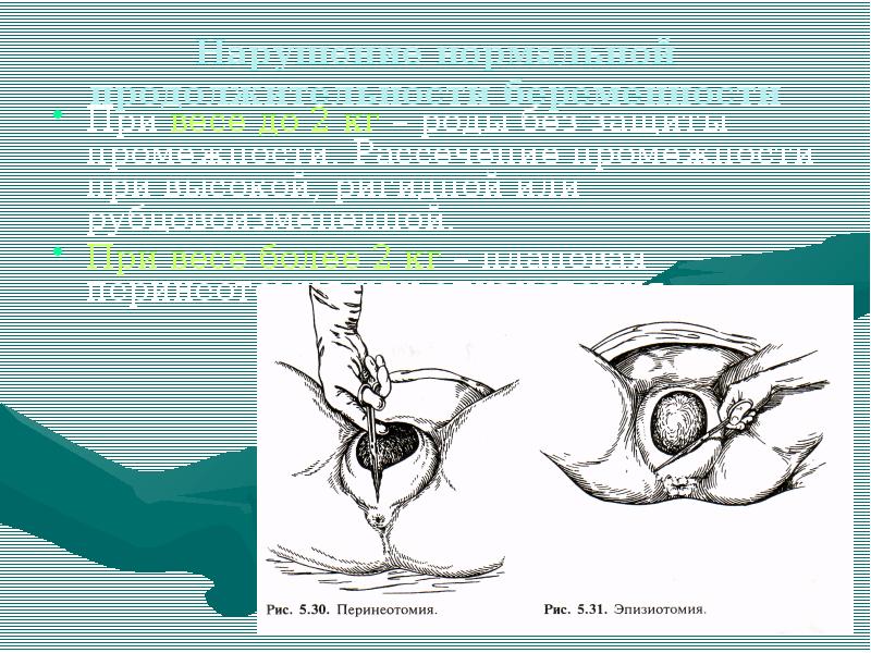 Перинеотомия и эпизиотомия презентация