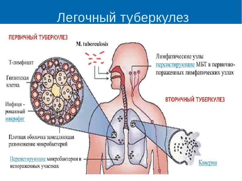 Легочный туберкулез презентация