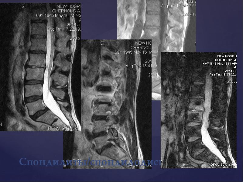 Спондилодисцит. Спондилит спондилодисцит. Спондилит спондилодисцит мрт. Спондилодисцит на кт. Спондилодисцит позвоночника мрт.
