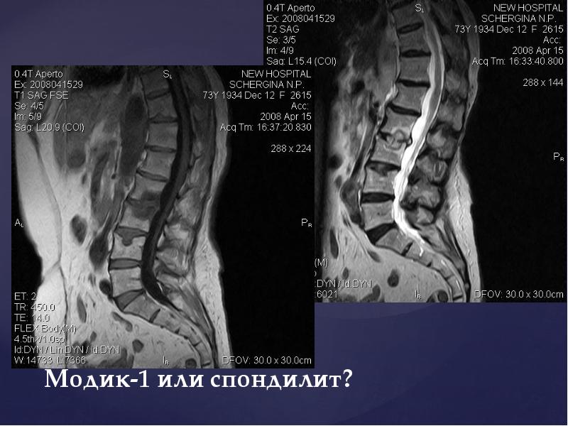 Модик 1. Modic мрт. Modic 3 на мрт. Асептический спондилит на мрт. Modic позвоночник.