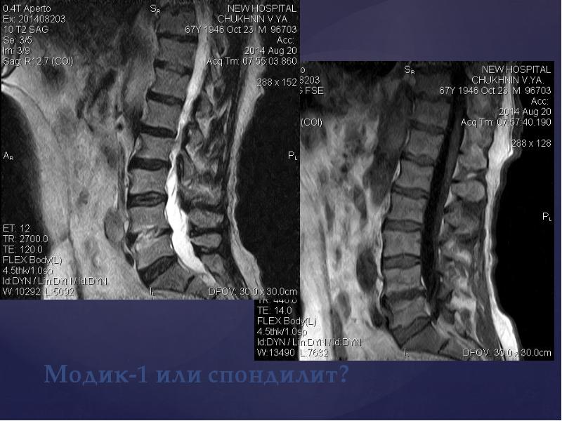 Модик 1. Modic мрт. Асептический спондилит на мрт. Модик 1 и модик 2 на мрт. Modic классификация мрт.