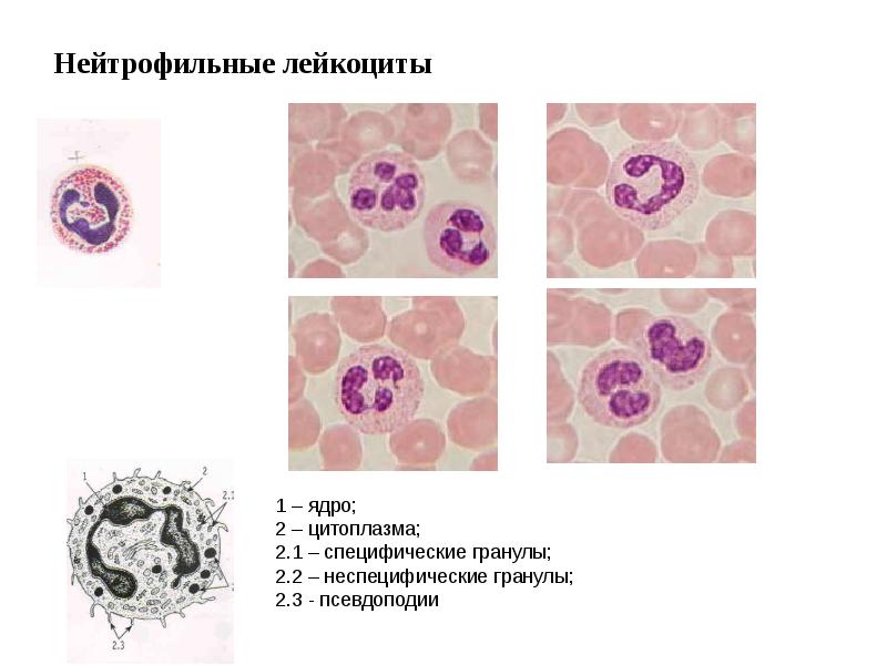 Нейтрофильный лейкоцитоз влево