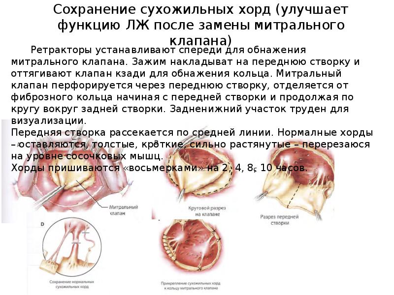 Наличие хорды у человека. Хорды митрального клапана анатомия. Сухожильные хорды митрального клапана. Реконструктивные операции на митральном клапане. Протез митрального клапана.