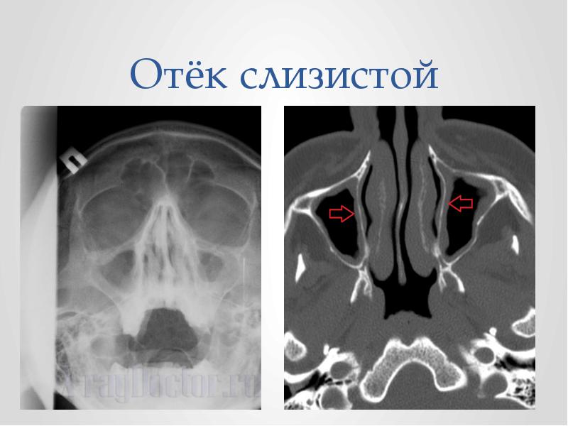 Ринит рентген картина