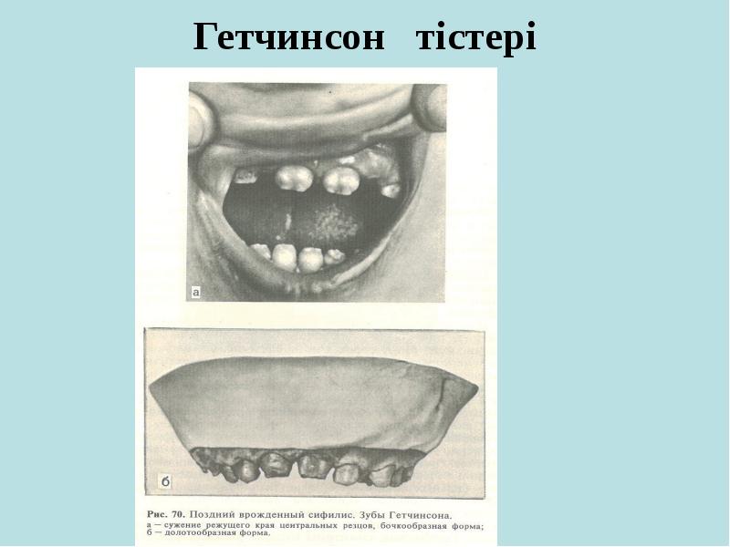 Гетчинсон тістері Гетчинсон тістері