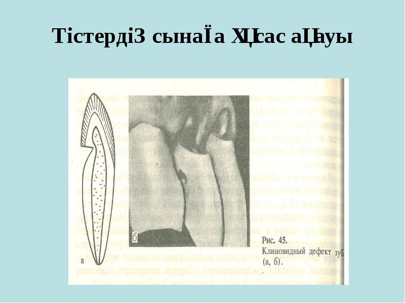 Тістердің сынаға ұқсас ақауы Тістердің сынаға ұқсас ақауы