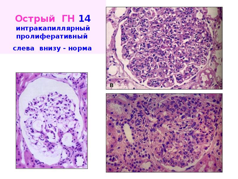 Эпидермальная пролиферативная единица гистология. Интракапиллярный пролиферативный гломерулонефрит микропрепарат. Пролиферативные заболевания. Интракапиллярный гломерулонефрит макропрепарат.