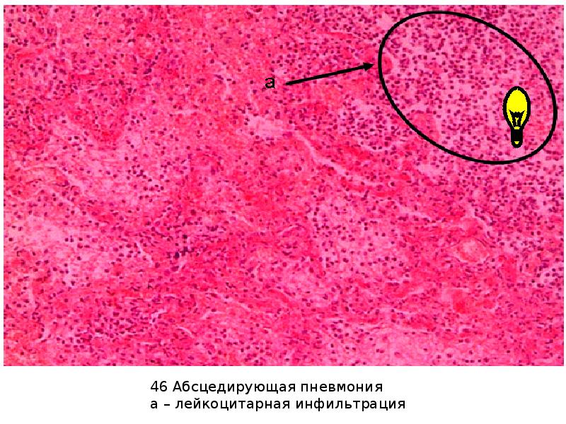 Что такое лейкоцитарная инфильтрация и как определить … Foto 18