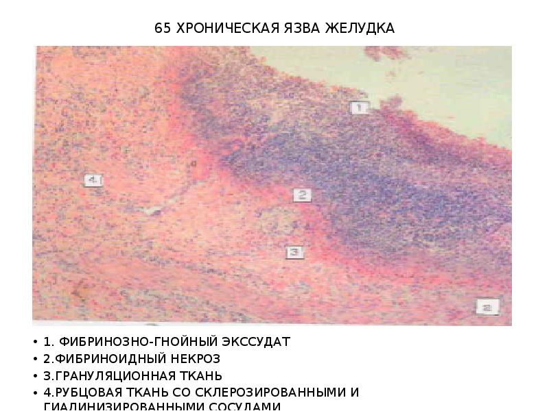 Хроническая язва желудка микропрепарат рисунок