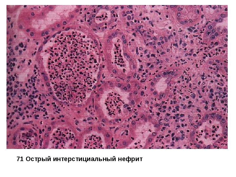 Интерстициальный нефрит симптомы у женщин. Интерстициальный нефрит патанатомия. Острый тубулоинтерстициальный нефрит гистология. Тубулоинтерстициальный нефрит патанатомия. Межуточный нефрит ПАТ анатомия.