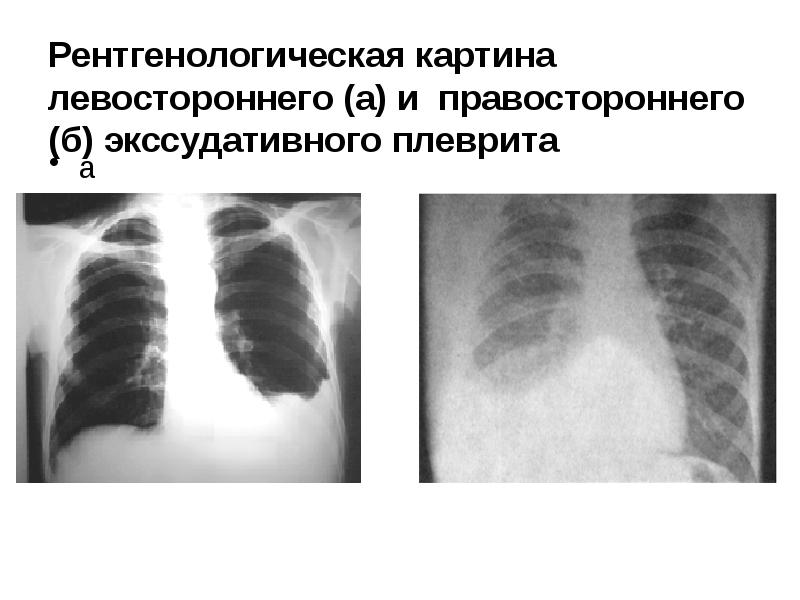 Правосторонний экссудативный плеврит. Правосторонний экссудативный плеврит. Экссудативный плеврит диагностика. Выпотной экссудативный плеврит. Правосторонний экссудативный плеврит.
