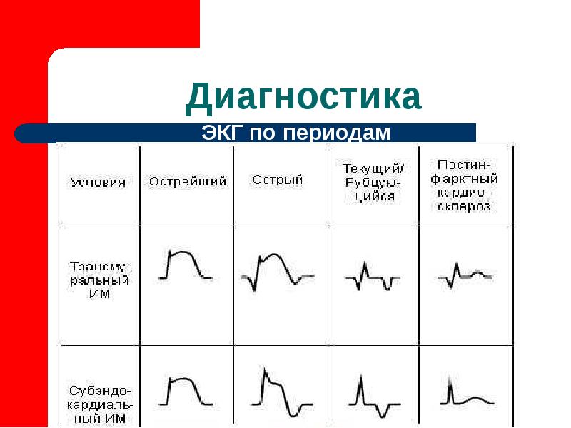 Острый инфаркт миокарда план обследования