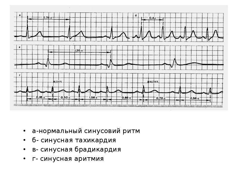 Тахикардия у подростка