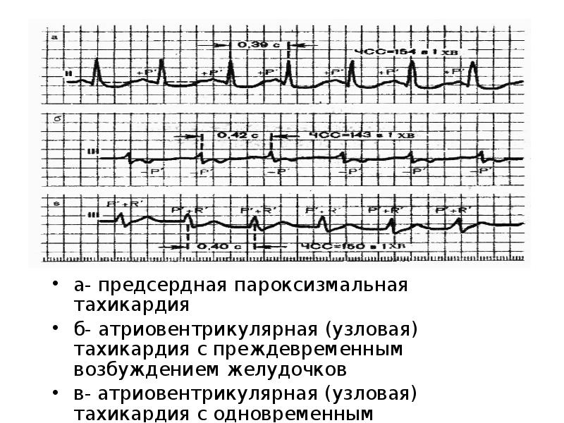 Пароксизмальная тахикардия карта смп