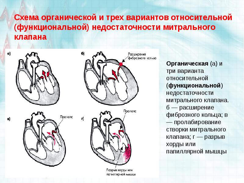 Приобретенные пороки сердца презентации