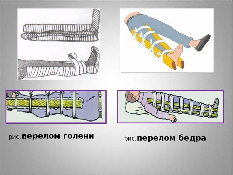 Основное правило наложения шины при переломе