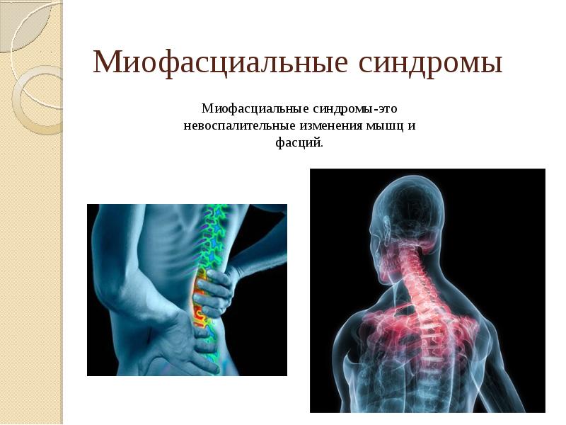 Миофасциальные синдромы Миофасциальные синдромы