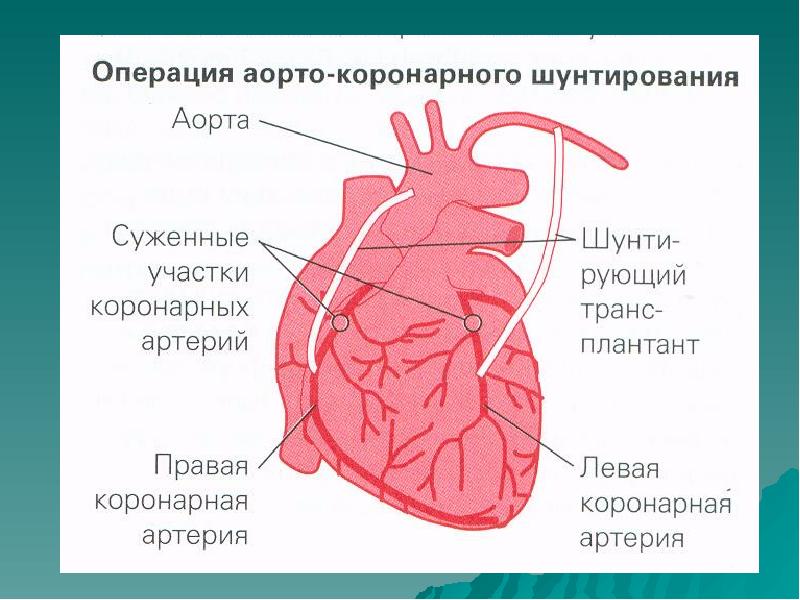 Схема коронарных артерий сердца по сегментам