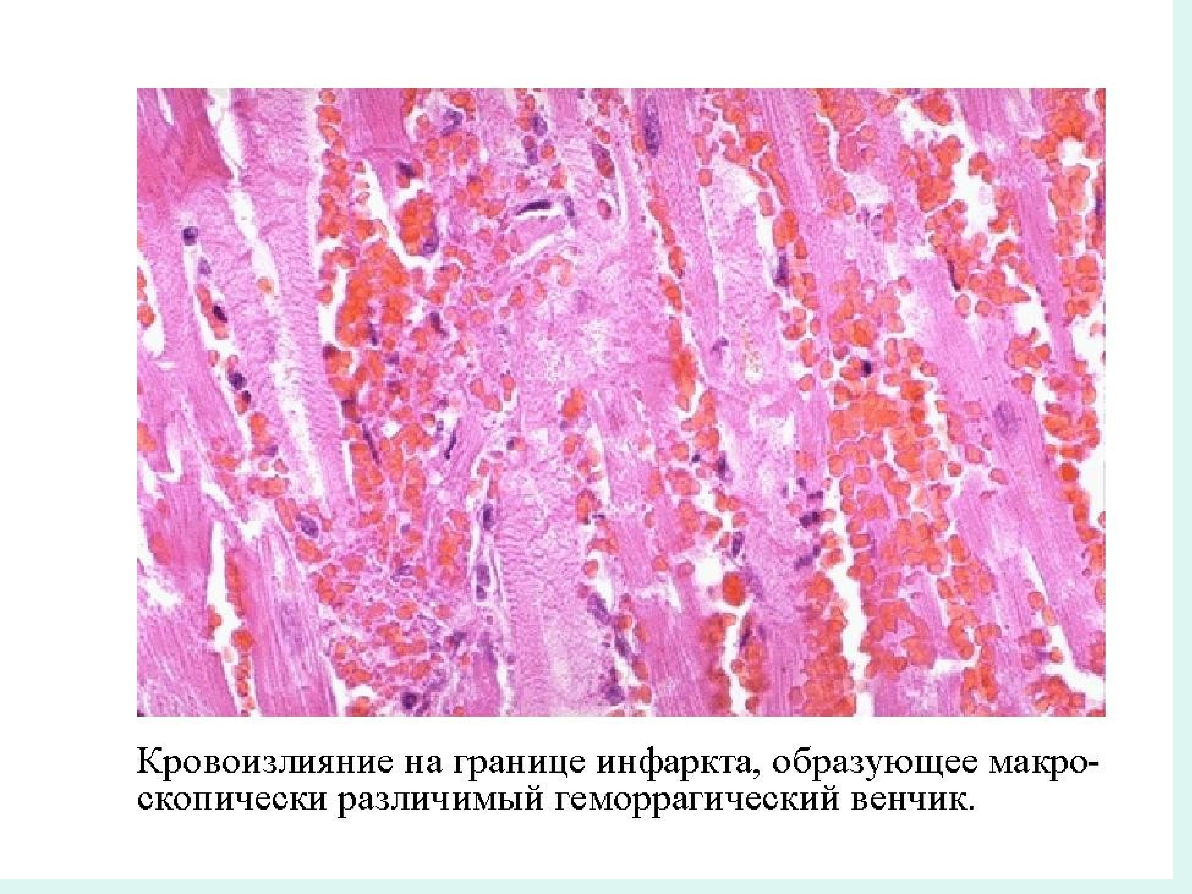 Сладж феномен патанатомия. Кровоизлияние в миокарде. Свадж феномен пат анатомия. Трансмуральный инфаркт миокарда гистология. Острый миокардит гистология.