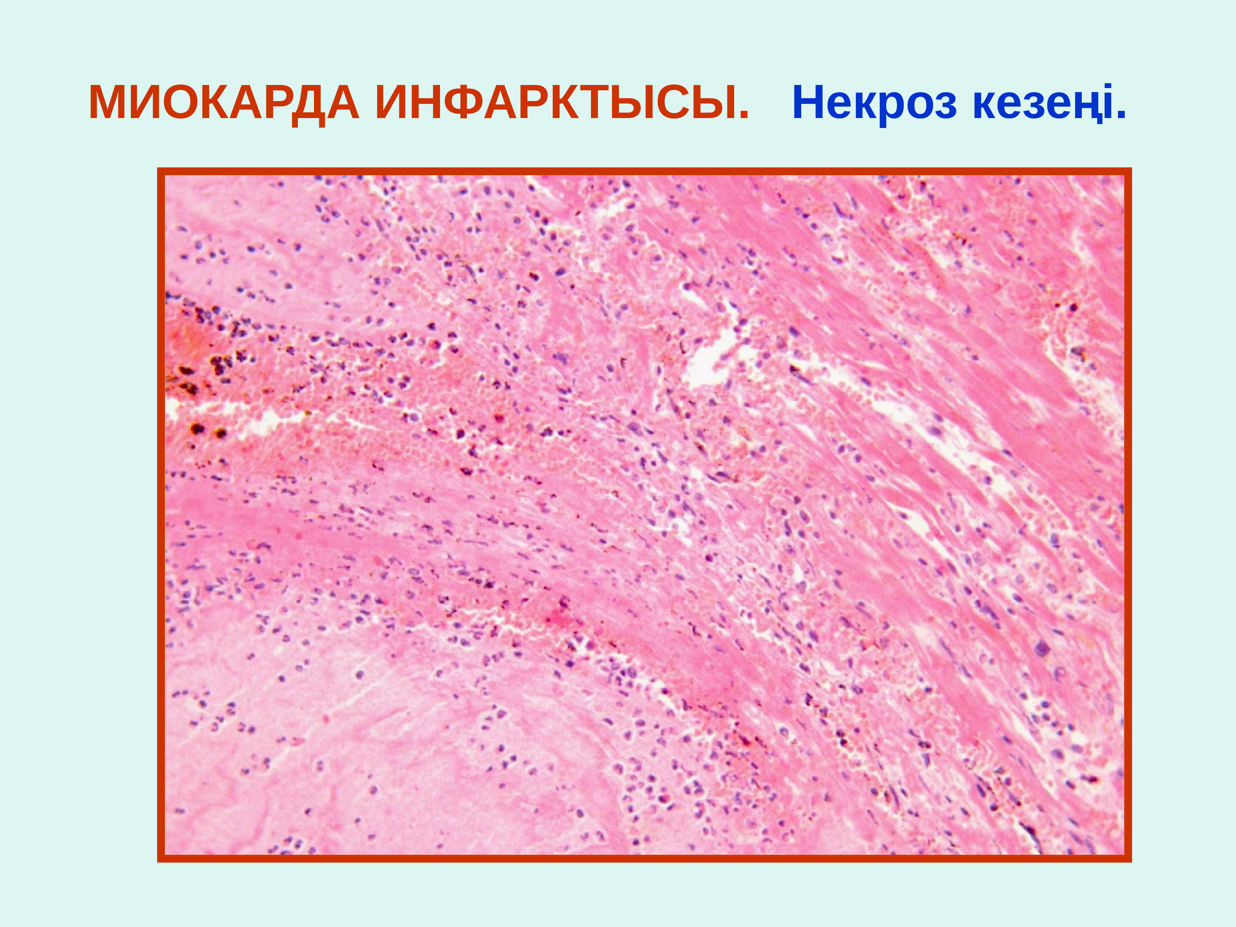 Инфаркт миокарда патологическая анатомия презентация