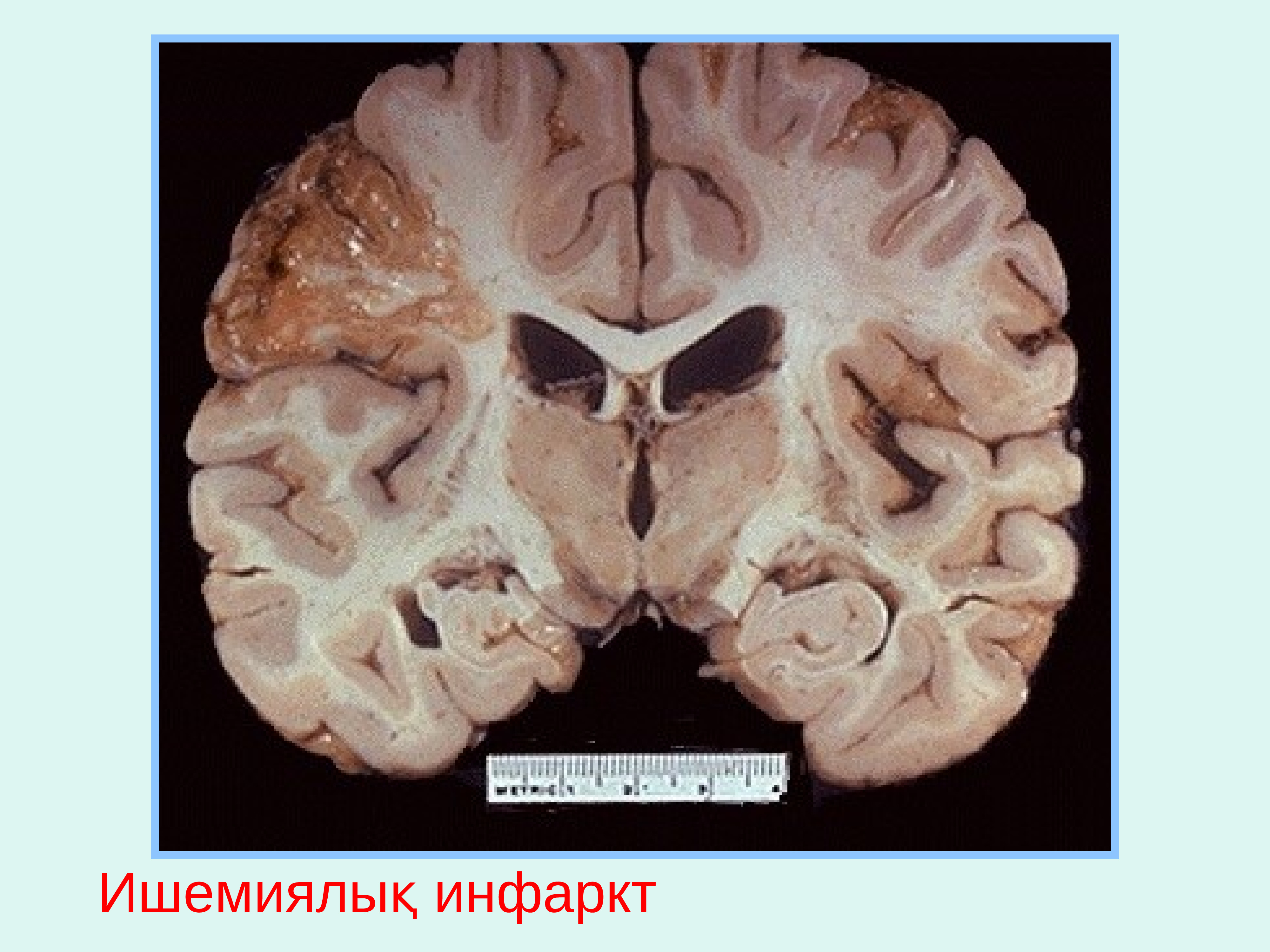 Диффузное поражение головного. Ишемический инфаркт головного мозга макропрепарат. Колликвационный некроз головного мозга. Болезнь Виллизиева круга. Киста головного мозга макропрепарат.