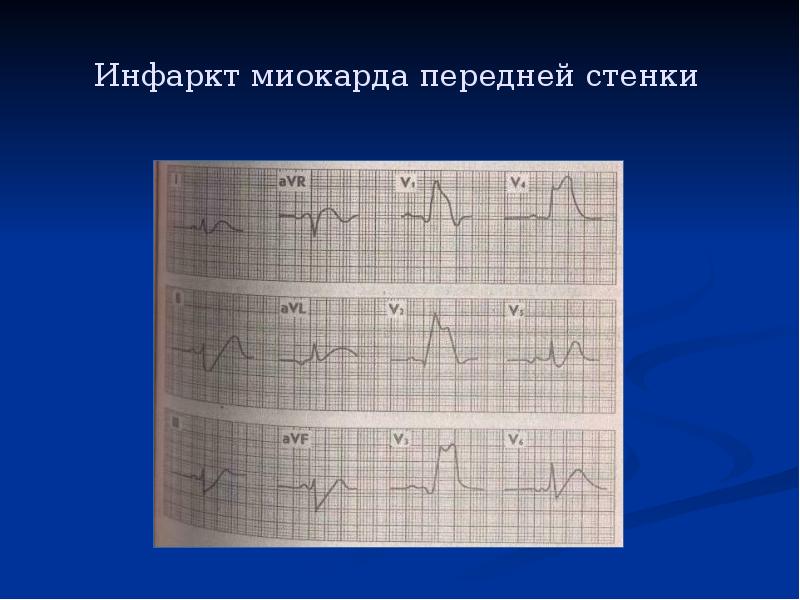 Ишемия переднебоковой стенки