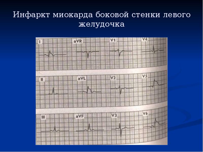 Нижняя стенка. Инфаркт боковой стенки на ЭКГ. Инфаркт миокарда боковой стенки на ЭКГ. Ишемия боковой и нижней стенки ЭКГ. Инфаркт миокарда Нижне боковой стенки ЭКГ.