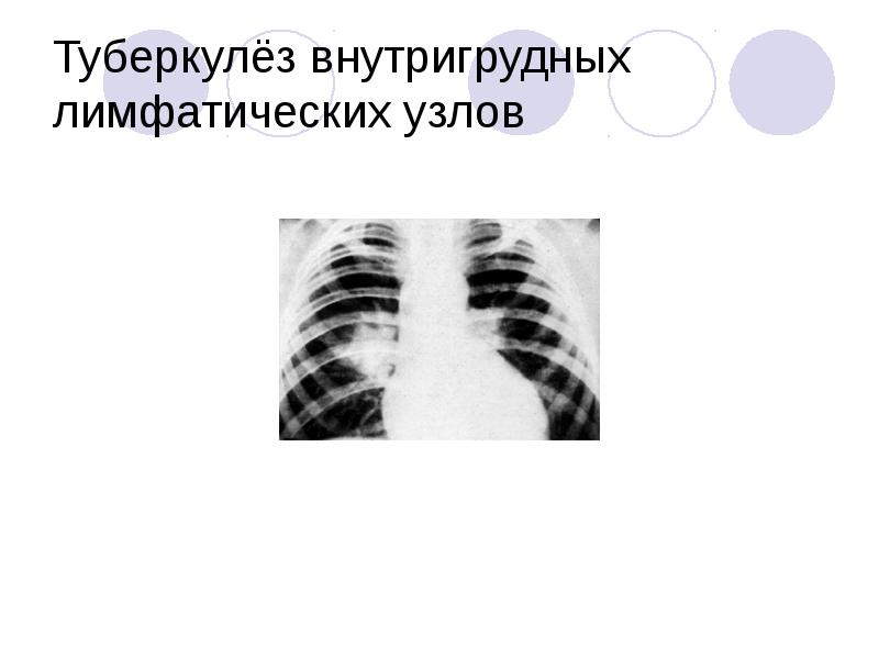 Туберкулез лимфатических узлов у детей. Туберкулез внутригрудных лимфатических узлов. туберкулез внутригрудных лимфатических узлов презентация. туберкулез внутригрудных лимфатических узлов у детей. туберкулез внутригрудных лимфатических узлов картинка.