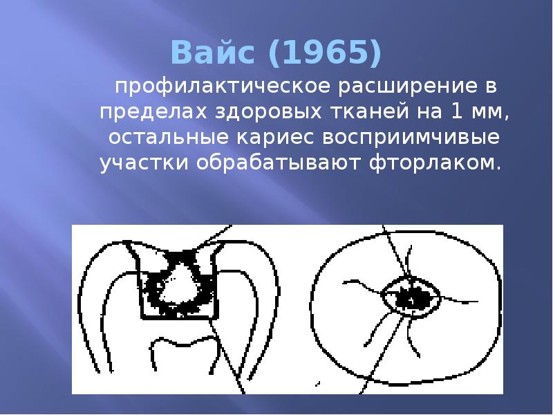 Вайс (1965)    профилактическое расширение в пределах здоровых тканей
