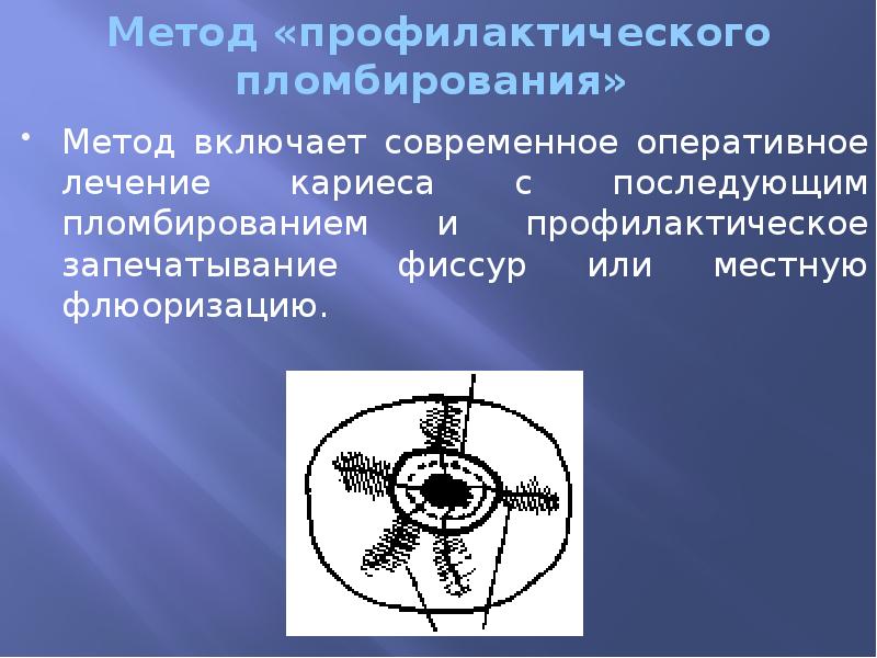 Метод «профилактического пломбирования»  Метод включает современное оперативное лечение кариеса с