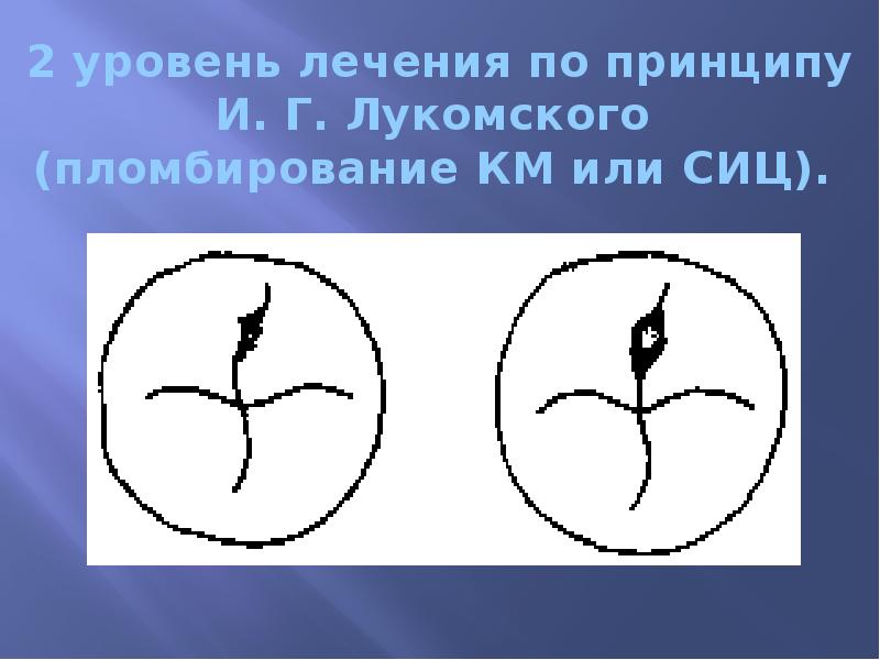 2 уровень лечения по принципу И. Г. Лукомского  (пломбирование КМ