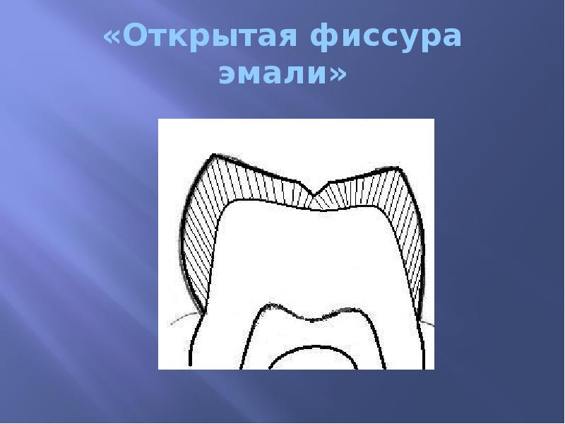 «Открытая фиссура эмали»