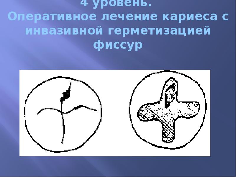 4 уровень.  Оперативное лечение кариеса с инвазивной герметизацией фиссур