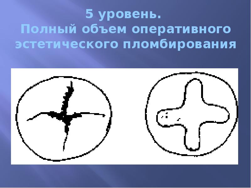 5 уровень.  Полный объем оперативного эстетического пломбирования