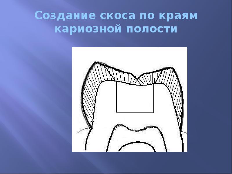 Создание скоса по краям кариозной полости