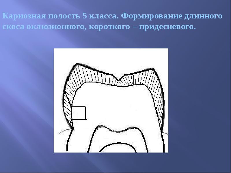 Кариозная полость 5 класса. Формирование длинного скоса оклюзионного, короткого – придесневого.