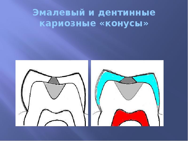 Эмалевый и дентинные кариозные «конусы»