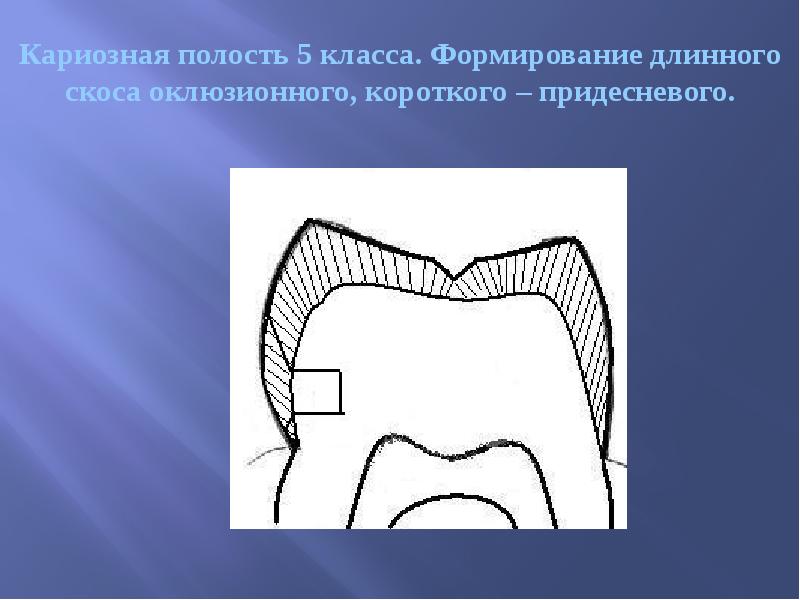 Кариозная полость 5 класса. Формирование длинного скоса оклюзионного, короткого – придесневого.