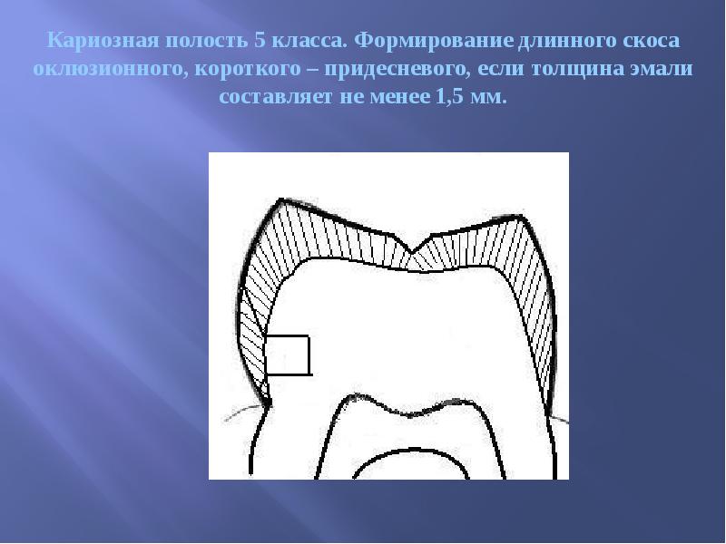Кариозная полость 5 класса. Формирование длинного скоса оклюзионного, короткого – придесневого,