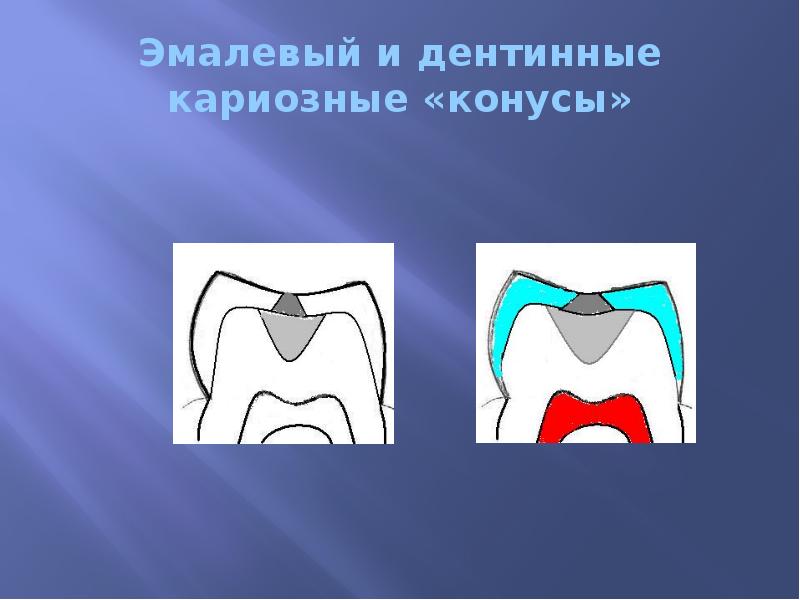 Эмалевый и дентинные кариозные «конусы»