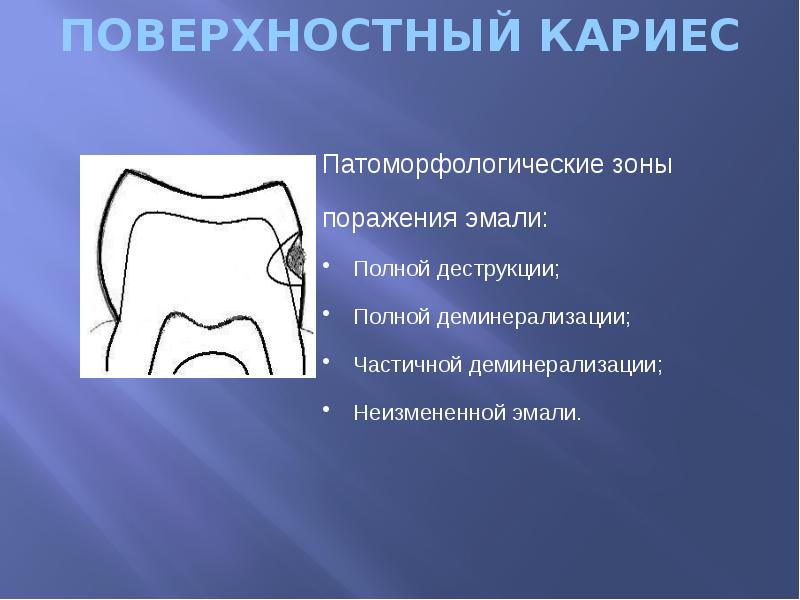 ПОВЕРХНОСТНЫЙ КАРИЕС