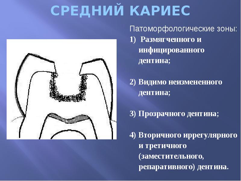 СРЕДНИЙ КАРИЕС
