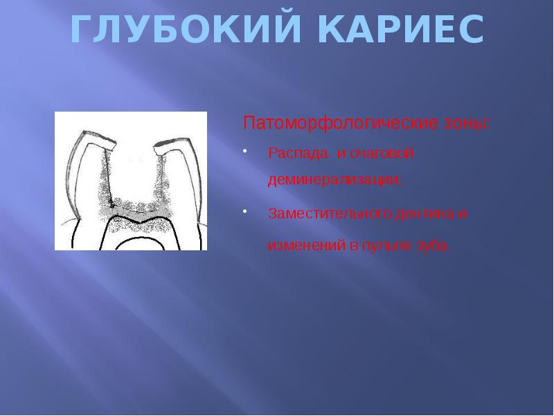 ГЛУБОКИЙ КАРИЕС Патоморфологические зоны: Распада и очаговой деминерализации; Заместительного дентина и
