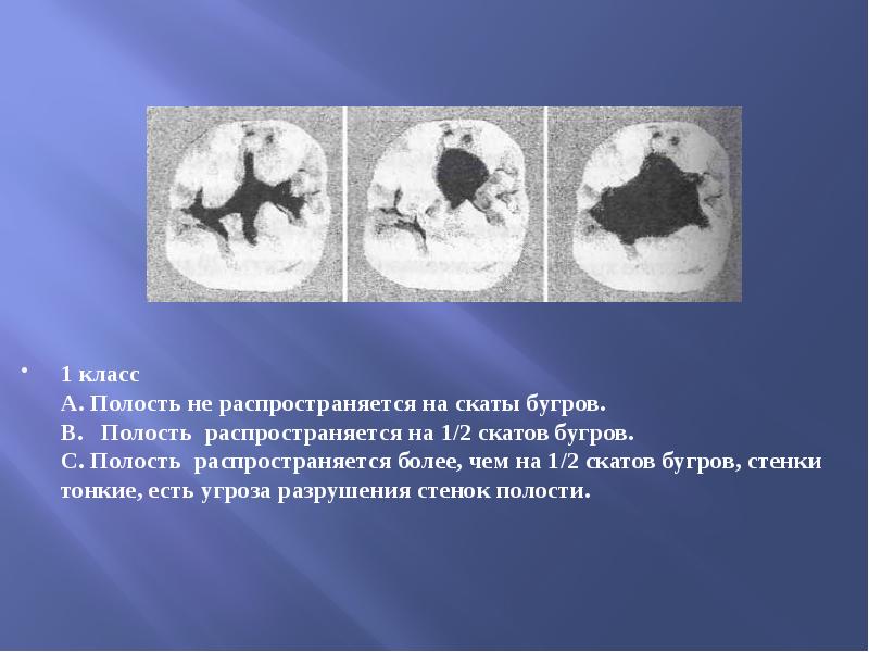 1 класс  А. Полость не распространяется на скаты бугров. В.