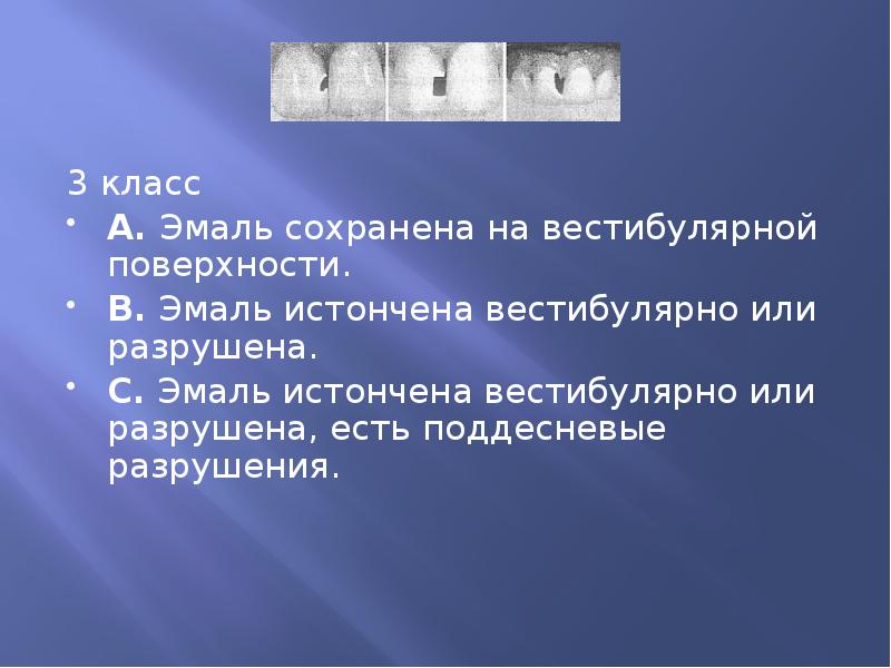 3 класс 3 класс А. Эмаль сохранена на вестибулярной поверхности. 