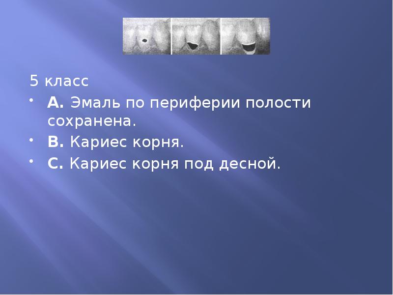 5 класс 5 класс А. Эмаль по периферии полости сохранена. В.